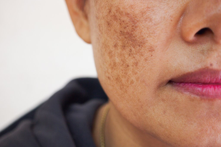 Stubborn Pigmentation